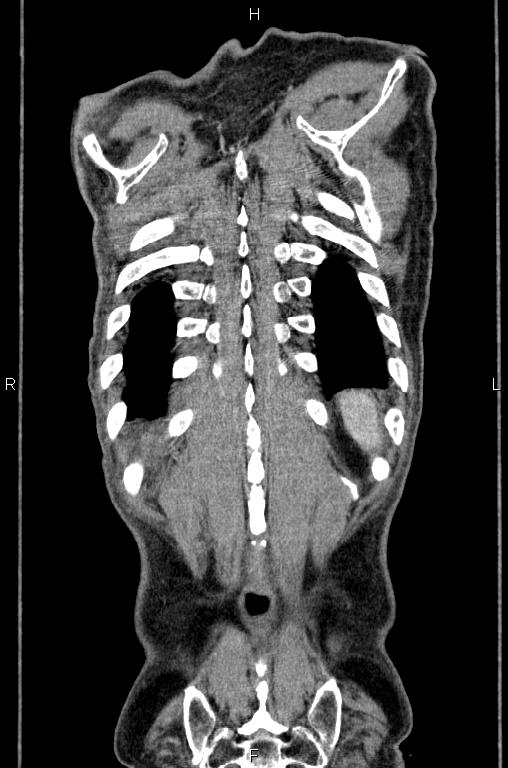 Ampullary adenocarcinoma (Radiopaedia 86093-102033 D 58).jpg