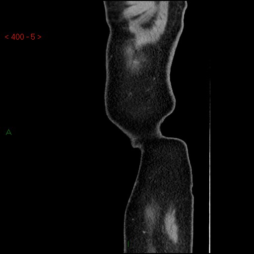 Ampullary carcinoma (Radiopaedia 56396-63056 D 4).jpg