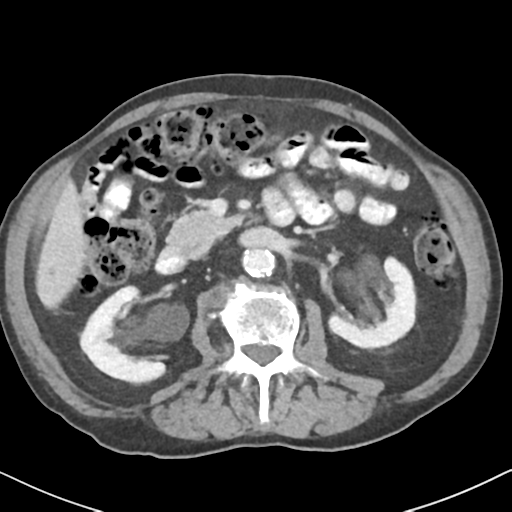 File:Amyand hernia (Radiopaedia 39300-41547 A 27).png