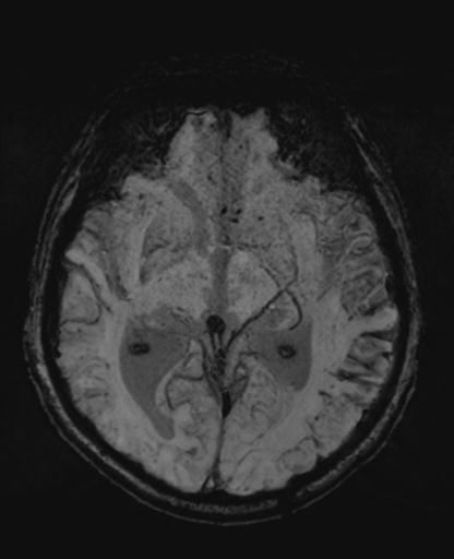 File:Amyloid angiopathy with inflammation (Radiopaedia 30360-31002 Axial SWI MIP 24).jpg