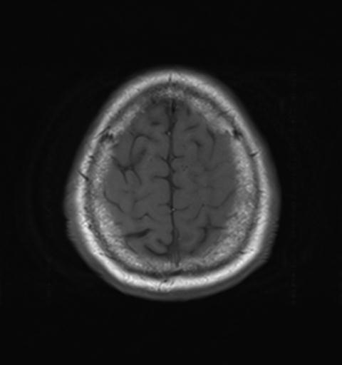 File:Amyloid angiopathy with inflammation (Radiopaedia 30360-31002 Axial T1 29).jpg