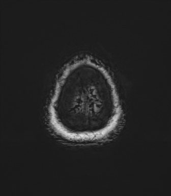 Anaplastic astrocytoma (Radiopaedia 86943-103160 Axial SWI 87).png