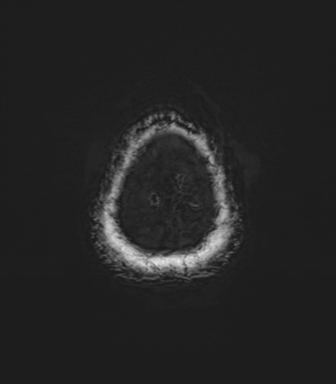 Anaplastic astrocytoma (Radiopaedia 86943-103160 Axial SWI 88).png