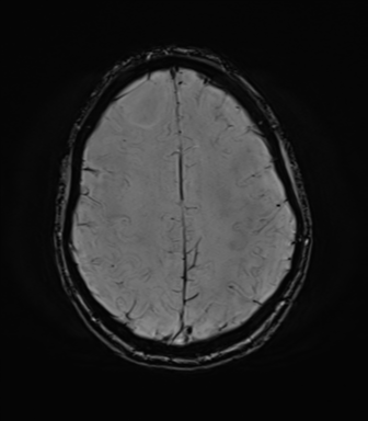 File:Anaplastic astrocytoma IDH mutant (Radiopaedia 50046-55341 Axial SWI 66).png