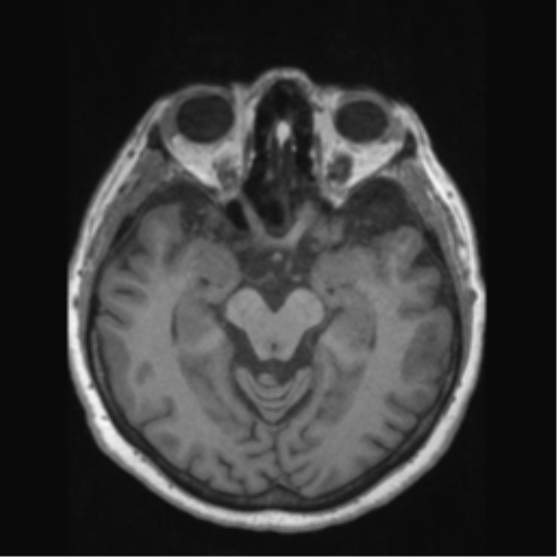 Anaplastic astrocytoma IDH wild-type (pseudoprogression) (Radiopaedia 42209-45276 Axial T1 65).png