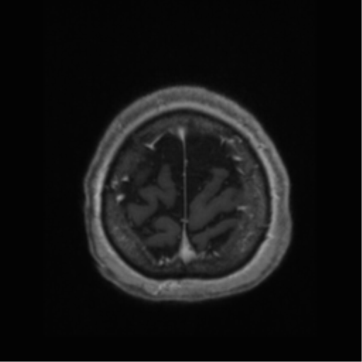 File:Anaplastic astrocytoma IDH wild-type (pseudoprogression) (Radiopaedia 42209-45277 Axial T1 C+ 117).png