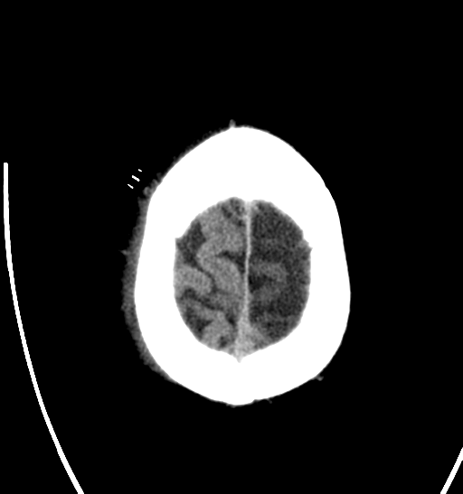 File:Anaplastic meningioma with recurrence (Radiopaedia 34452-35786 Axial non-contrast 29).png