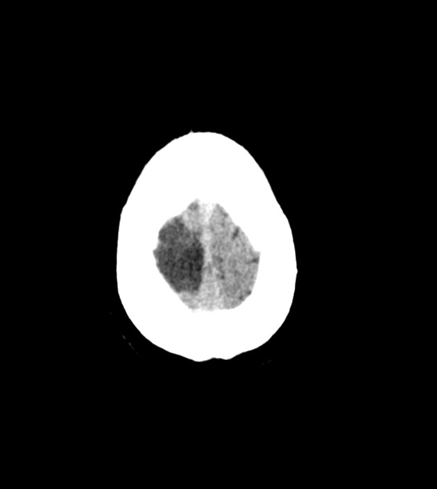 Anaplastic oligodendroglioma (Radiopaedia 79571-92758 Axial non-contrast 46).jpg