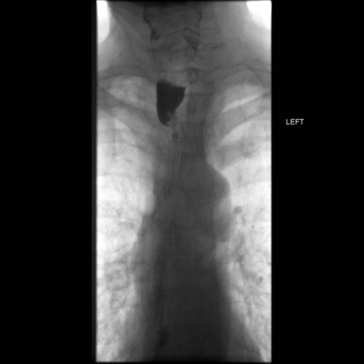File:Anastomotic stricture post Ivor Lewis esophagectomy (Radiopaedia 47937-52715 Frontal 21).png