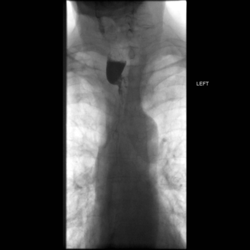 File:Anastomotic stricture post Ivor Lewis esophagectomy (Radiopaedia 47937-52715 Frontal 24).png