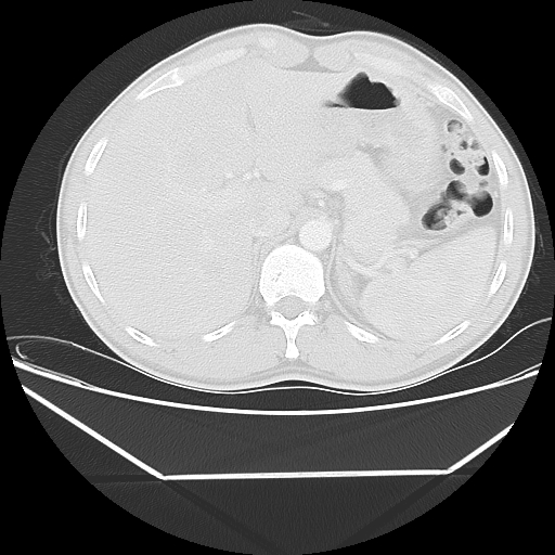 File:Aneurysmal bone cyst - rib (Radiopaedia 82167-96220 Axial lung window 61).jpg