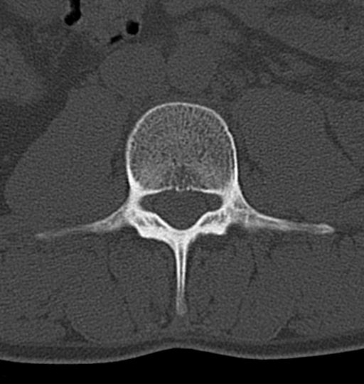 Aneurysmal bone cyst T11 (Radiopaedia 29294-29721 Axial bone window 89).jpg