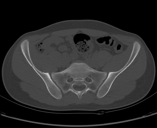 File:Aneurysmal bone cyst of ischium (Radiopaedia 25957-26094 Axial bone window 23).png