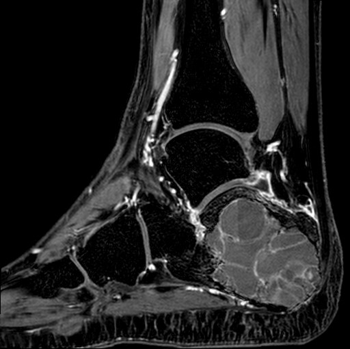 File:Aneurysmal bone cyst of the calcaneus (Radiopaedia 60669-68420 F 18).jpg