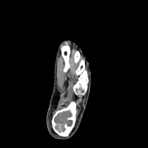 File:Aneurysmal bone cyst of the calcaneus (Radiopaedia 60669-68421 A 35).jpg