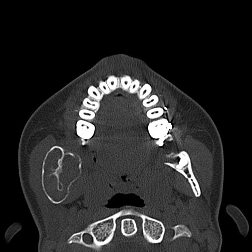 Aneurysmal bone cyst of the mandible (Radiopaedia 43280-46601 Axial bone window 40).jpg