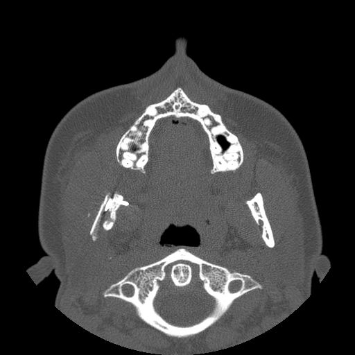 Aneurysmal bone cyst of the mandible (Radiopaedia 43280-46823 Axial bone window 91).jpg