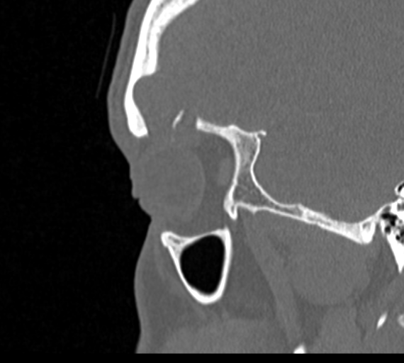 Angular epidermoid cyst (Radiopaedia 46908-51439 Sagittal bone window 79).png