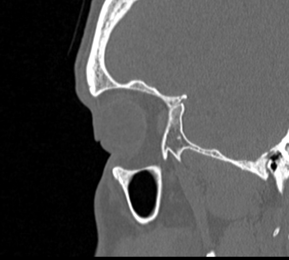 Angular epidermoid cyst (Radiopaedia 46908-51439 Sagittal bone window 9).png