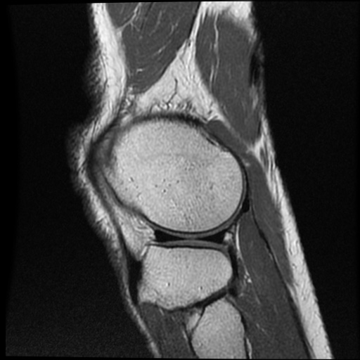 Anomalous insertion of the medial meniscus (Radiopaedia 77559-89721 Sagittal PD 13).jpg