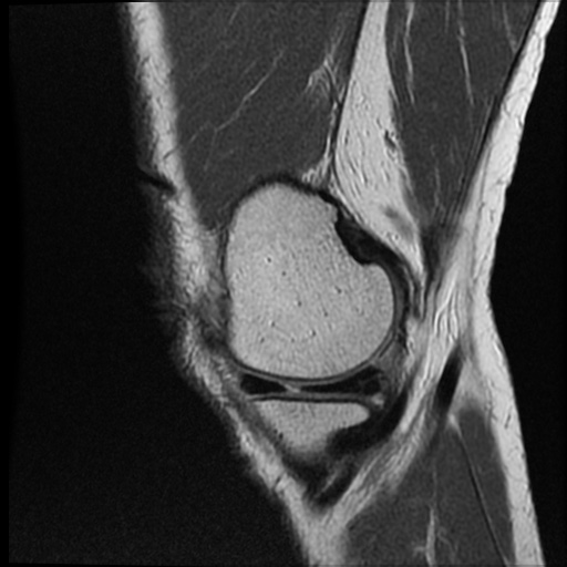 Anomalous insertion of the medial meniscus (Radiopaedia 77559-89721 Sagittal PD 43).jpg