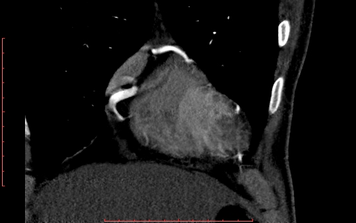 Anomalous left coronary artery from the pulmonary artery (ALCAPA) (Radiopaedia 70148-80181 B 56).jpg