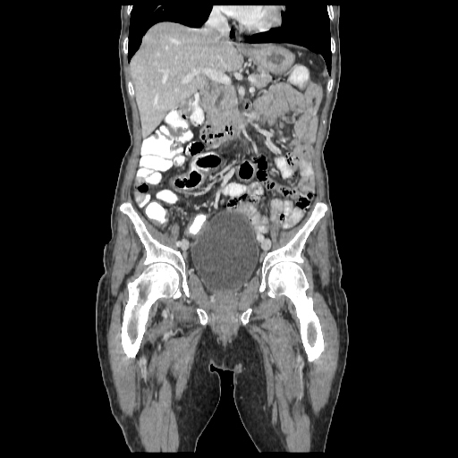 Anorectal carcinoma (Radiopaedia 44413-48064 B 33).jpg