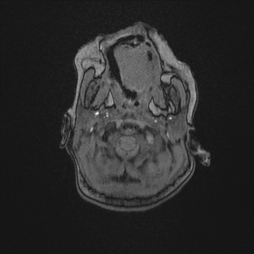 Anoxic brain injury (Radiopaedia 79165-92139 Axial MRA 11).jpg