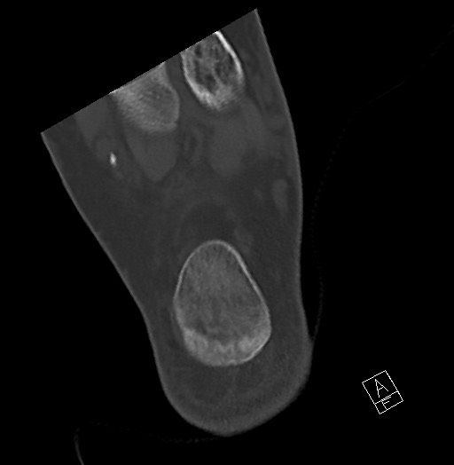 Anterior calcaneal process fracture (Radiopaedia 63353-71943 Axial bone window 118).jpg