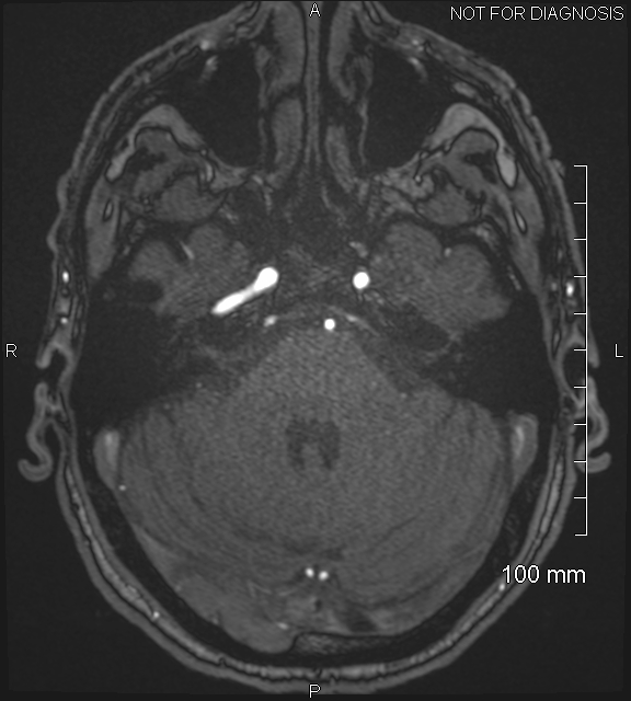 Anterior cerebral artery aneurysm (Radiopaedia 80683-94127 Axial MRA 57).jpg