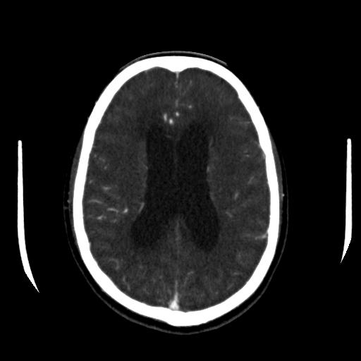 File:Anterior communicating artery aneurysm (Radiopaedia 16633-16335 A 28).jpg