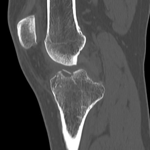 File:Anterior cruciate ligament avulsion fracture (Radiopaedia 58939-66194 Sagittal bone window 24).jpg