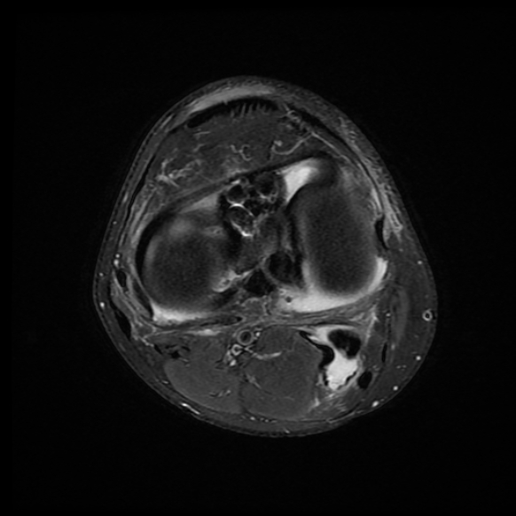 File:Anterior cruciate ligament graft tear and bucket-handle tear of medial meniscus (Radiopaedia 75867-87255 Axial PD fat sat 8).jpg