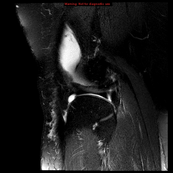File:Anterior cruciate ligament tear (Radiopaedia 12329-12612 E 4).jpg