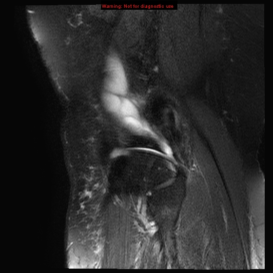 File:Anterior cruciate ligament tear - complete (Radiopaedia 12175-12514 Sagittal T2 fat sat 3).jpg