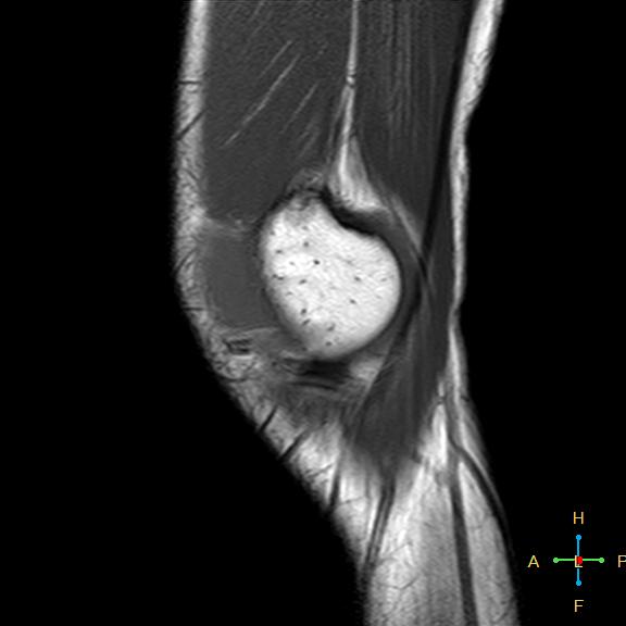 File:Anterior cruciate ligament tear - complete (Radiopaedia 24907-25170 Sagittal T1 17).jpg