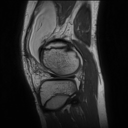 Anterior cruciate ligament tear - pediatric (Radiopaedia 62152-70260 Sagittal PD 136).jpg