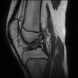Anterior cruciate ligament tear - pediatric (Radiopaedia 62152-70260 Sagittal PD 89).jpg