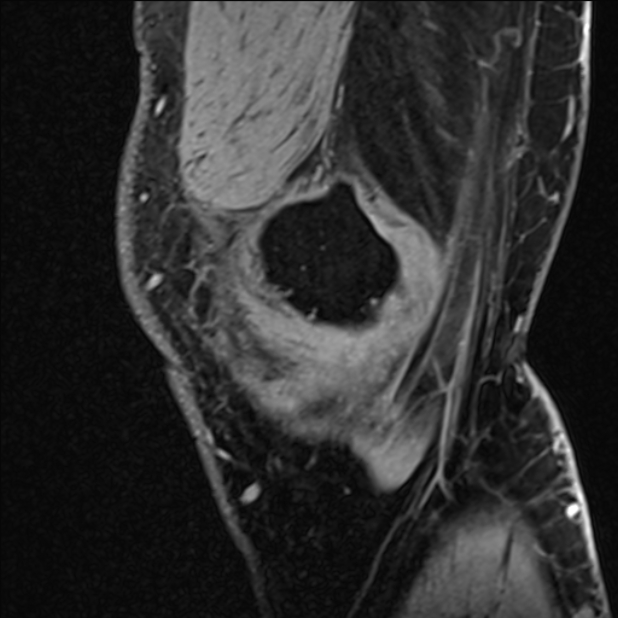 Anterior cruciate ligament tear - ramp lesion (Radiopaedia 71883-82322 Sagittal T1 vibe 122).jpg