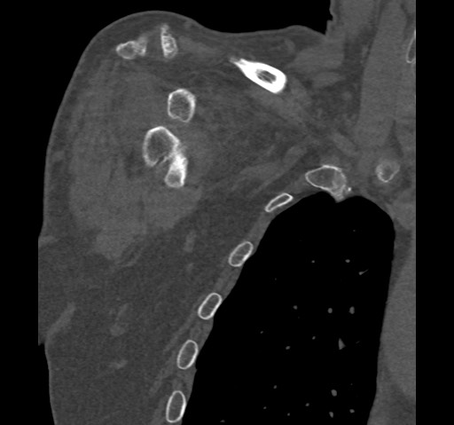 Anterior glenohumeral dislocation with Hill-Sachs lesion (Radiopaedia 62877-71249 Coronal bone window 13).jpg