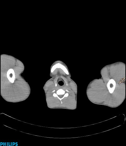 File:Anterior mediastinal seminoma (Radiopaedia 80270-93613 C 6).jpg