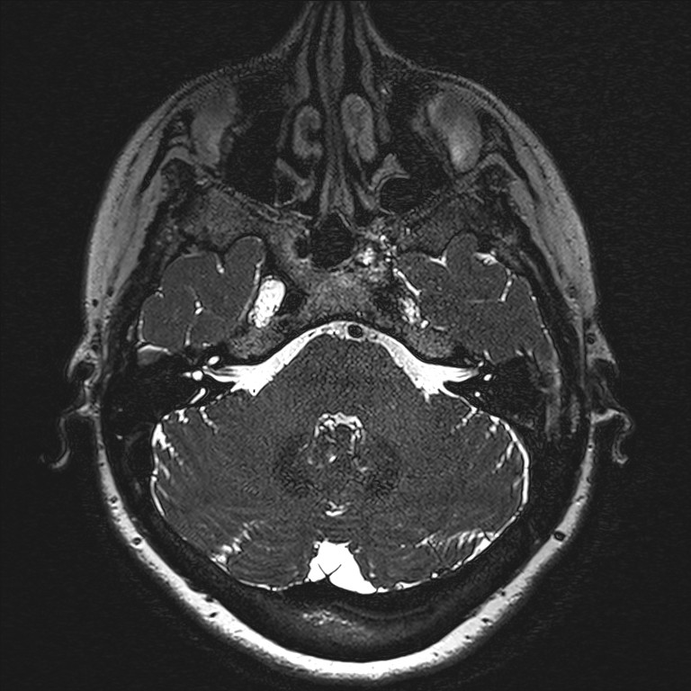 Anterior temporal encephalocele (Radiopaedia 82624-96808 Axial T2 high res 19).jpg
