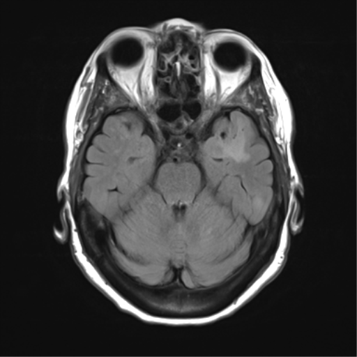File:Anterior temporal pole cysts (Radiopaedia 46629-51102 Axial FLAIR 9).png