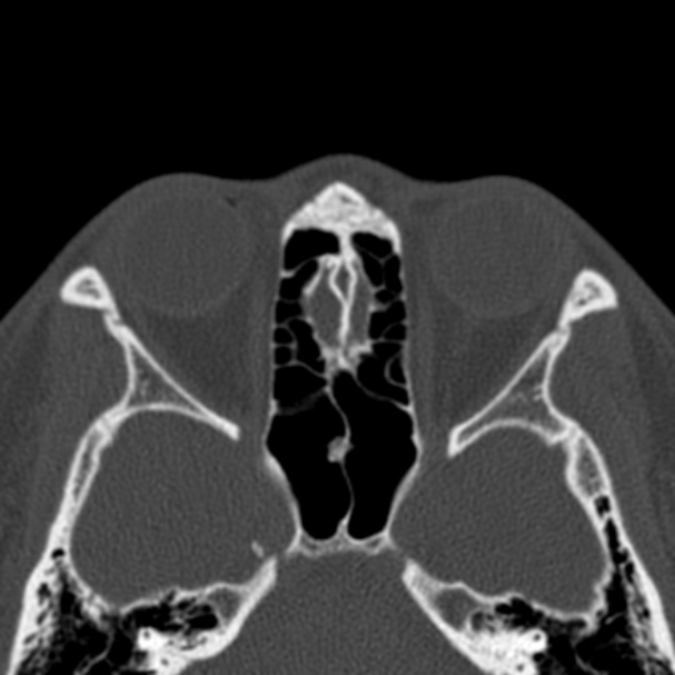 Antrochoanal polyp (Radiopaedia 33984-35202 Axial bone window 54).jpg