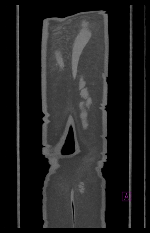 Aortectomy and axillary-bifemoral bypass (Radiopaedia 28303-28545 C 92).jpg