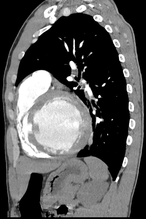 Aortic coarctation with aneurysm (Radiopaedia 74818-85828 B 109).jpg
