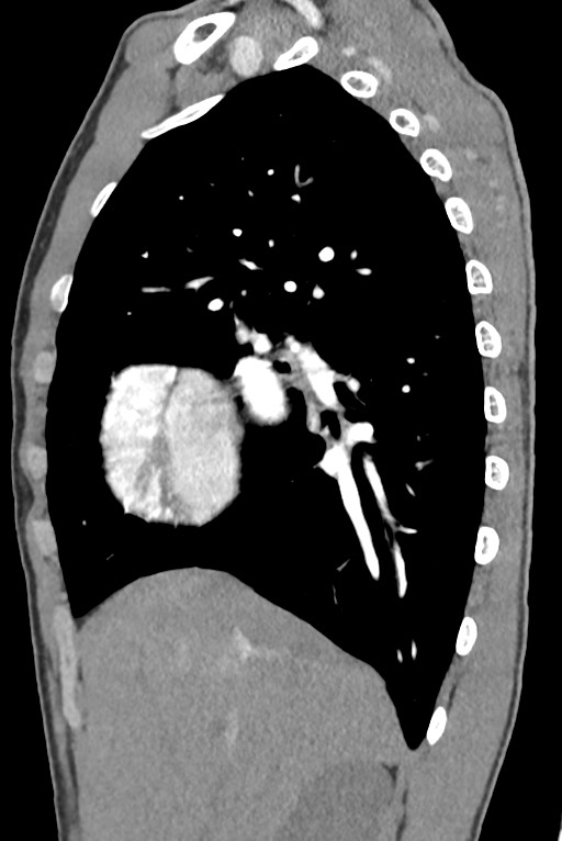 Aortic coarctation with aneurysm (Radiopaedia 74818-85828 B 52).jpg