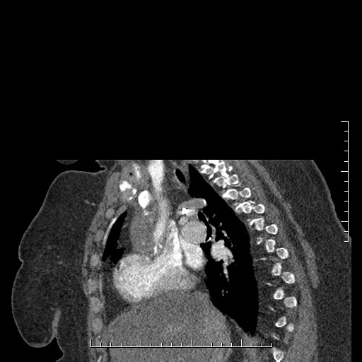 File:Aortic dissection- Stanford A (Radiopaedia 35729-37268 D 41).jpg