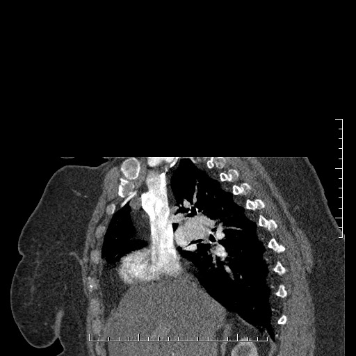 File:Aortic dissection- Stanford A (Radiopaedia 35729-37268 D 45).jpg