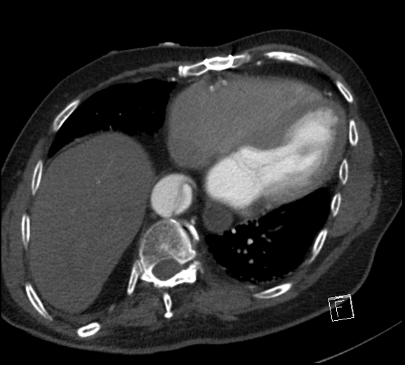 File:Aortic dissection (CTPA) (Radiopaedia 75506-86750 A 67).jpg